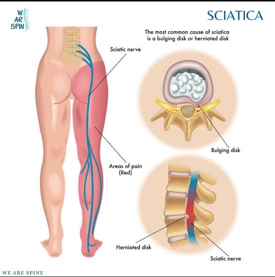 Sciatica Treatment in Jaipur: How Physiotherapy Helps Relieve Radiating Leg Pain